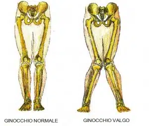 Ginocchio Valgo